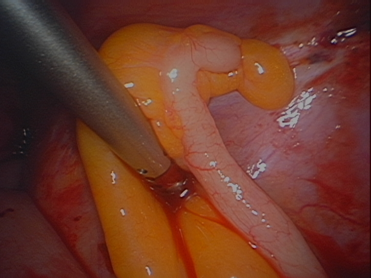 endometriosis normal appendix serag youssif